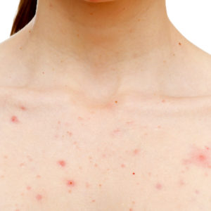acne chest numelab skincare acne chest numelab skincare