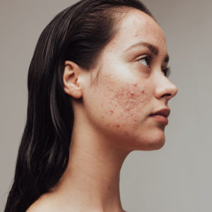 acne woman face numelab skincare acne woman face numelab skincare