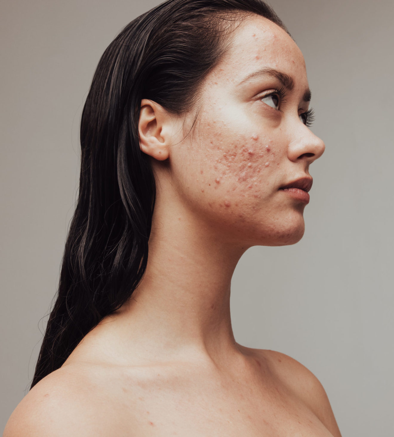 Purging or Breakouts 8 Actives that Cause Purging NUMELab