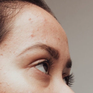 acne purging numelab skincare acne purging numelab skincare