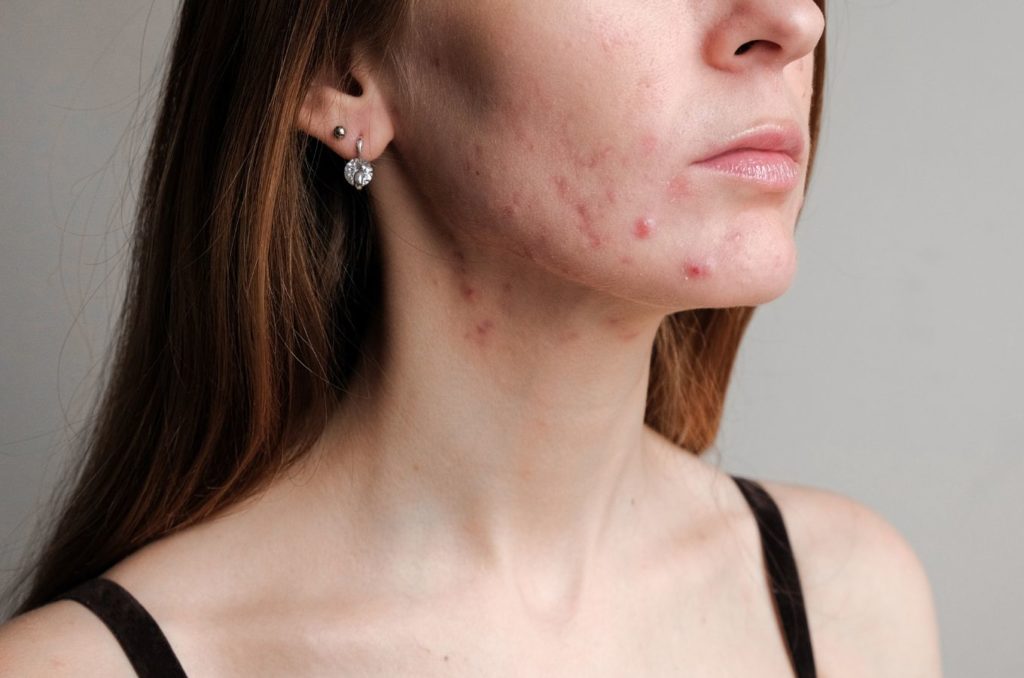 acne skin numelab skincare