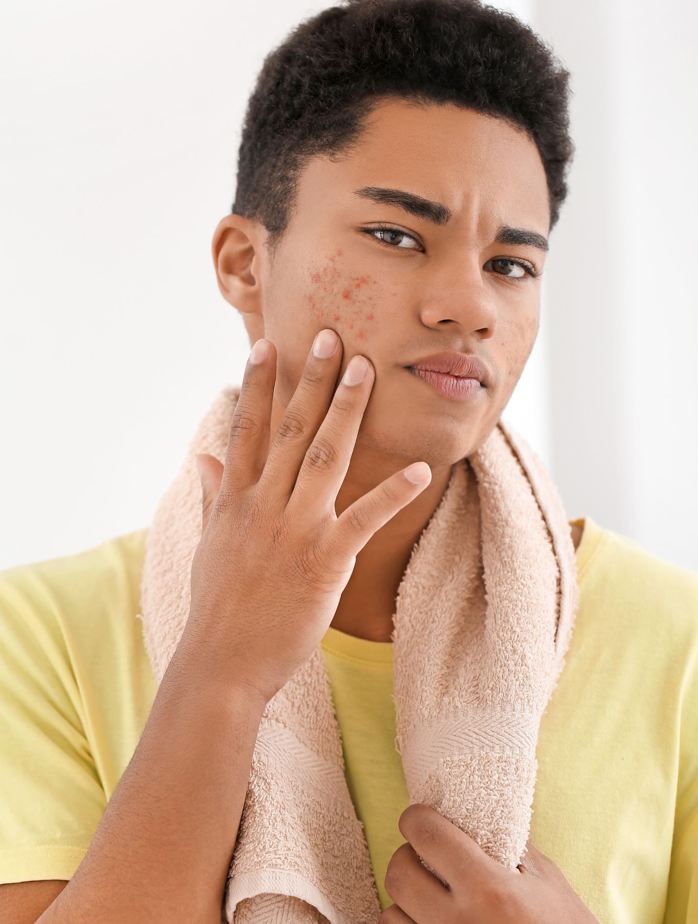 purging acne skin numelab
